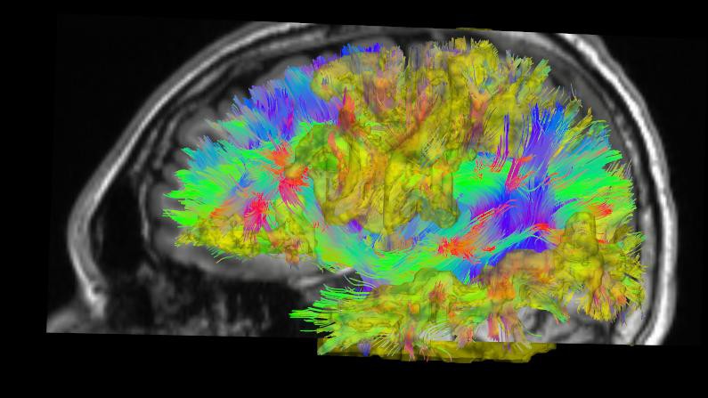 En jaune, les régions cérébrales dont la connectivité est affectée chez les patients schizophrènes © Patric Hagmann/CHUV