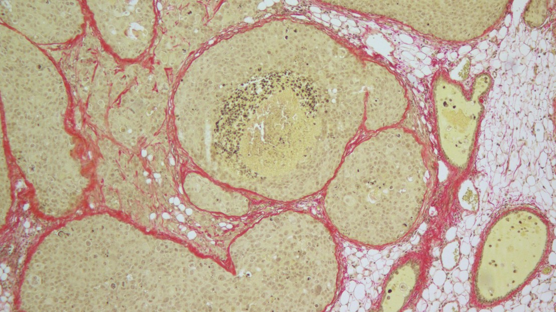 Immunohistochimie sur tissu de cancer du sein à récepteurs du hormone positif d’un xénogreffe intracanalaire, teinté pour les réseaux de collagène fibrillaire © G. Sflomos/EPFL