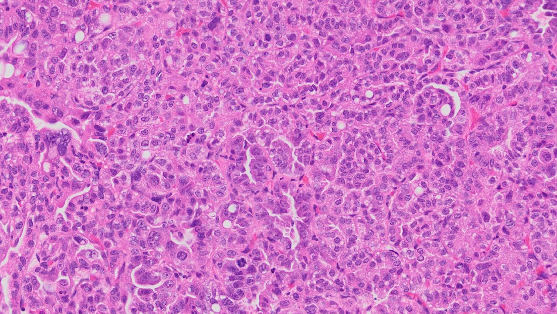 Histological staining of a lung adenocarcinoma, which is made of tumor cells as well as cells of the immune microenvironment including tumor-associated neutrophils. Credit: Caroline Contat (EPFL).