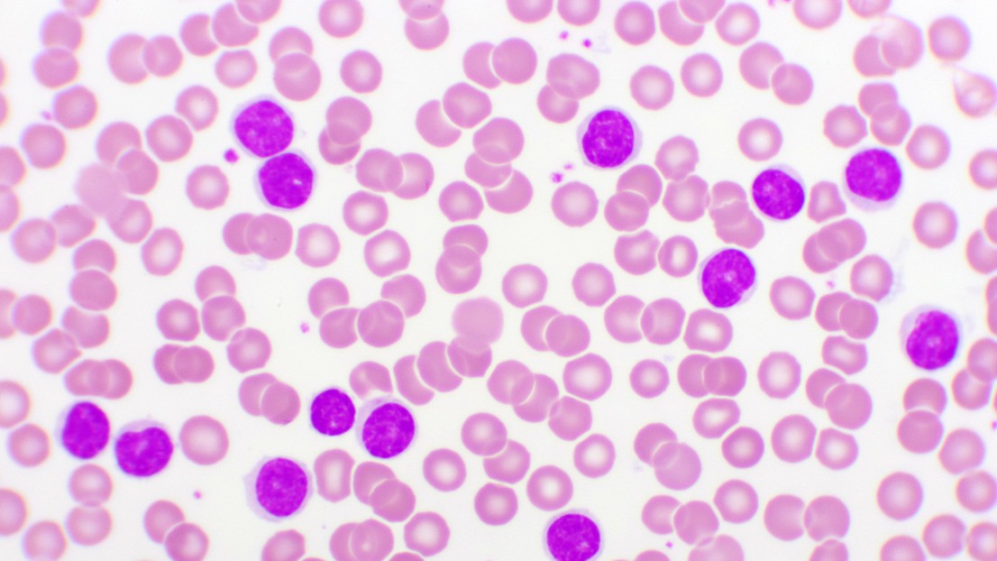 Frottis sanguin de la leucémie lymphocytaire chronique (LLC), analyse au microscope. EPFL / iStock