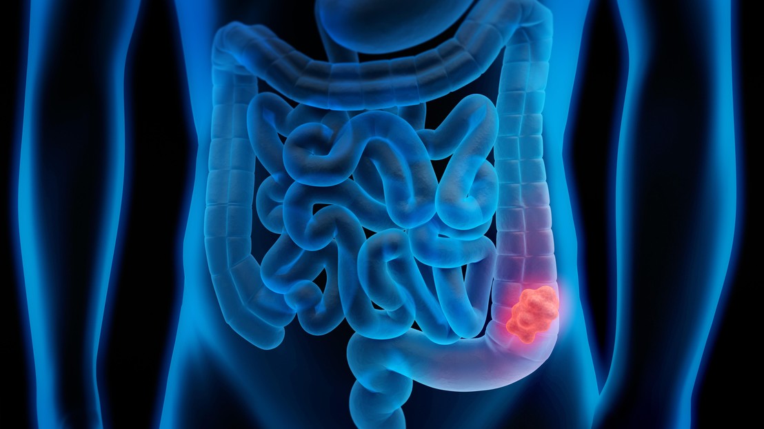 Le cancer colorectal est l’un des cancers les plus courants dans les pays occidentaux. © Stock