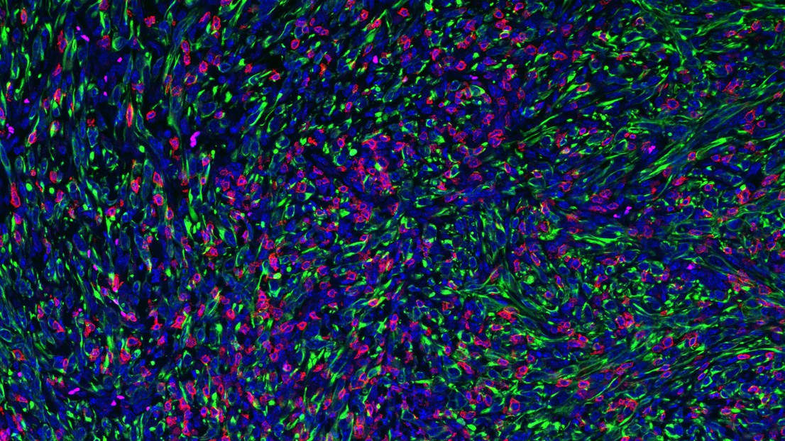 Tumeur dont les cellules cancéreuses sont dépourvues de FMRP (en vert) infiltrées par des cellules T tueuses (CD8). Crédit: Jeremy Guillot (laboratoire Hanahan – EPFL)