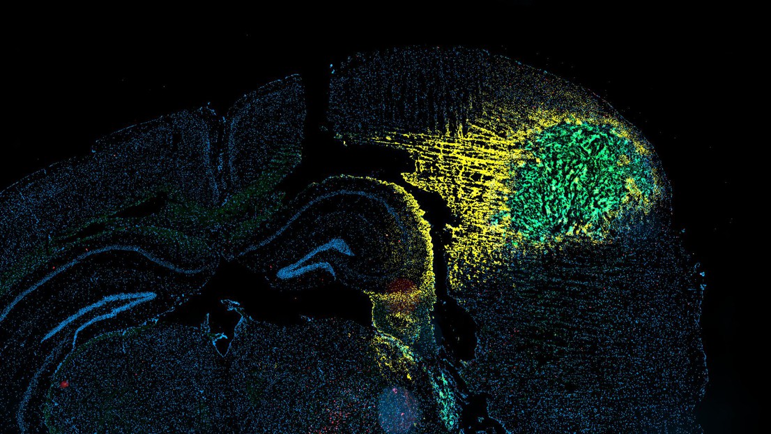 Cerebral tumor (glioma) of a mouse - 2023 EPFL / Michele De Palma -  CC-BY-SA 4.0