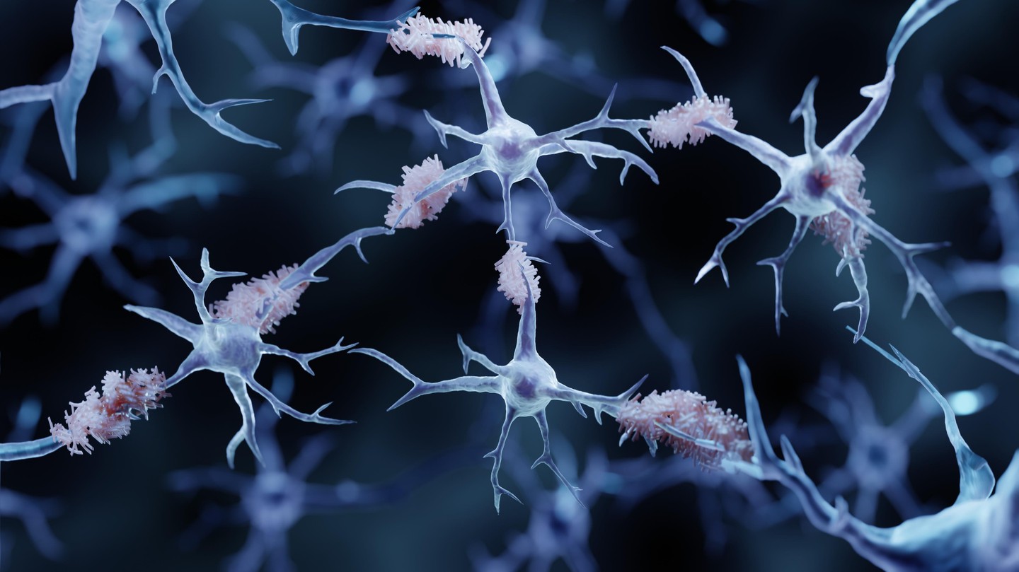 Amyloid plaques in Alzheimer's disease ©EPFL/iStock photos (Artur Plawgo)