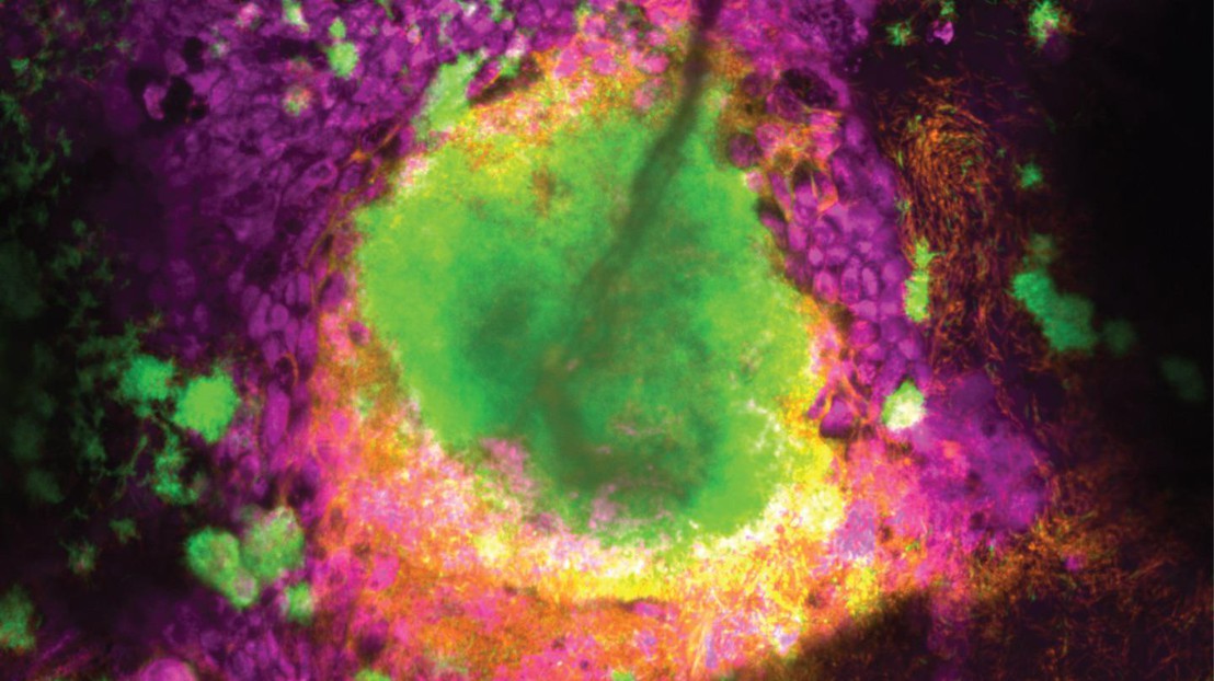 Biofilm formé par deux souches de P. aeruginosa (chronique en vert, aigu en orange) se développant à l'intérieur de l'épithélium des voies respiratoires (magenta). Crédit: L. Meirelles (EPFL)