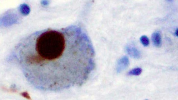 L'alpha synucléine teintée, dans un neurone CC / Marvin 101