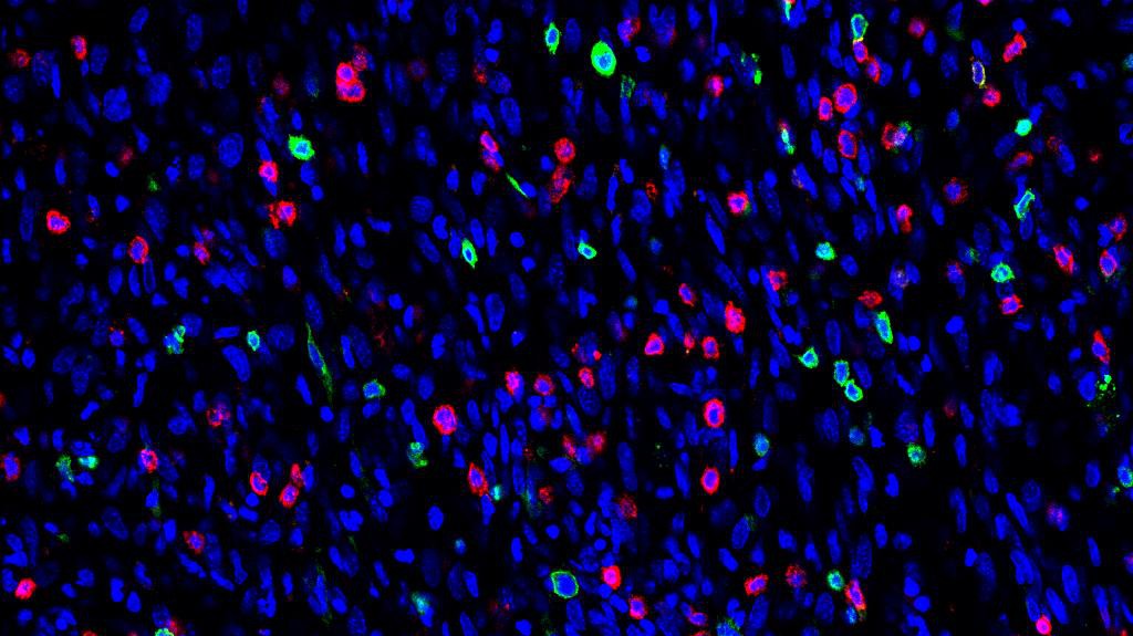 Des lymphocytes (rouge et vert) et des cellules cancéreuses (bleu) © M. De Palma / EPFL