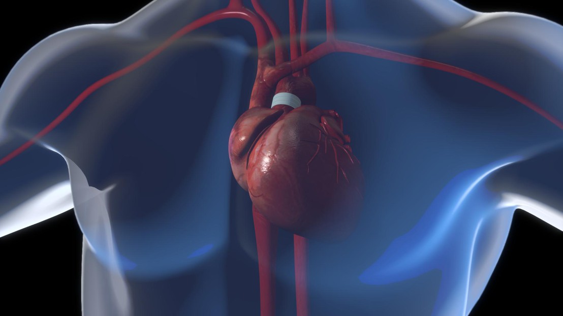 The system consists in three  rings placed around the aorta. © 2016 EPFL/ J.Caillet