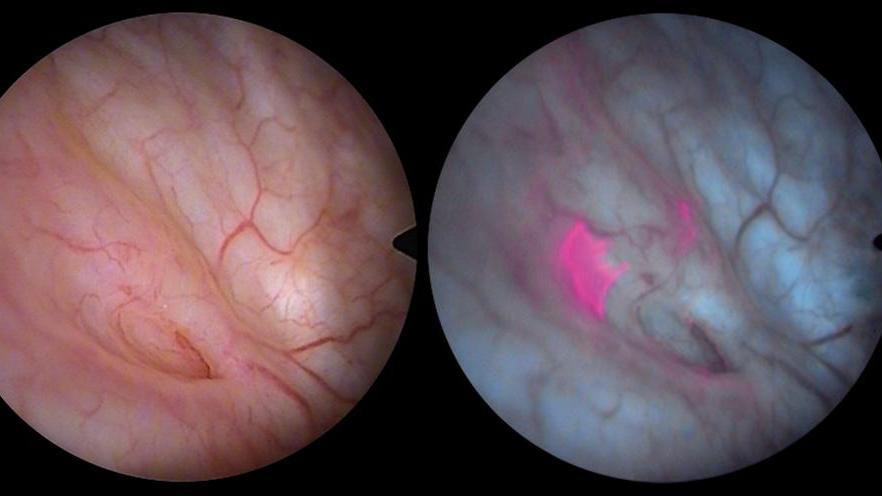 On the left, an invisible bladder tumor. On the right, blue light reveals its presence.