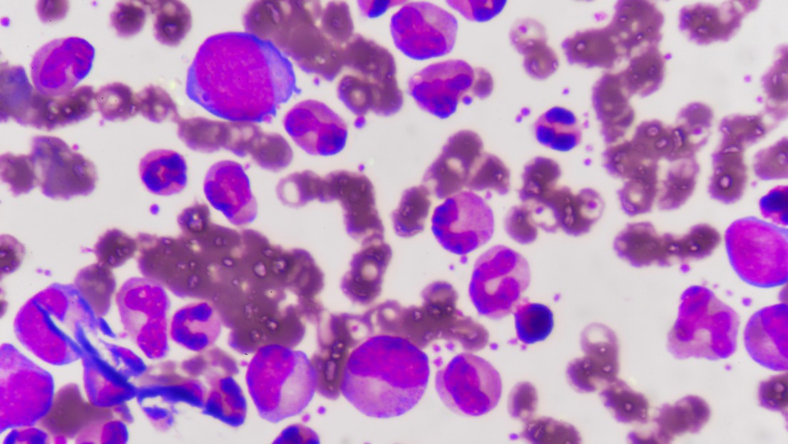 Blast cells in leukemia (iStock Photos)