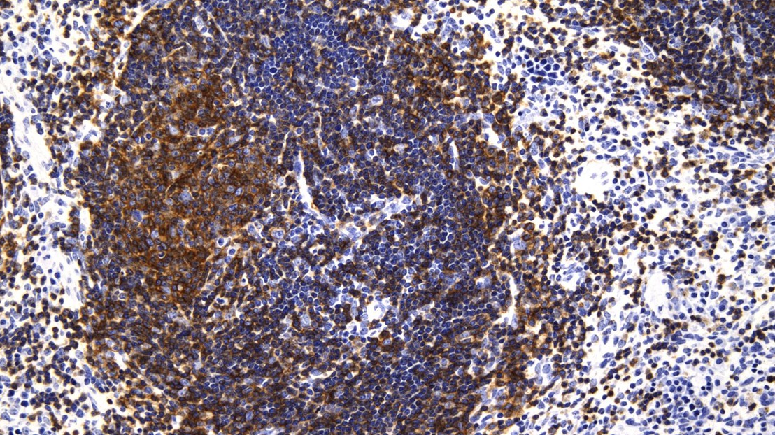 Expansion et accumulation de cellules de lymphome (colorées en brun) dans la rate de souris. Crédit: Natalya Katanayeva (EPFL)