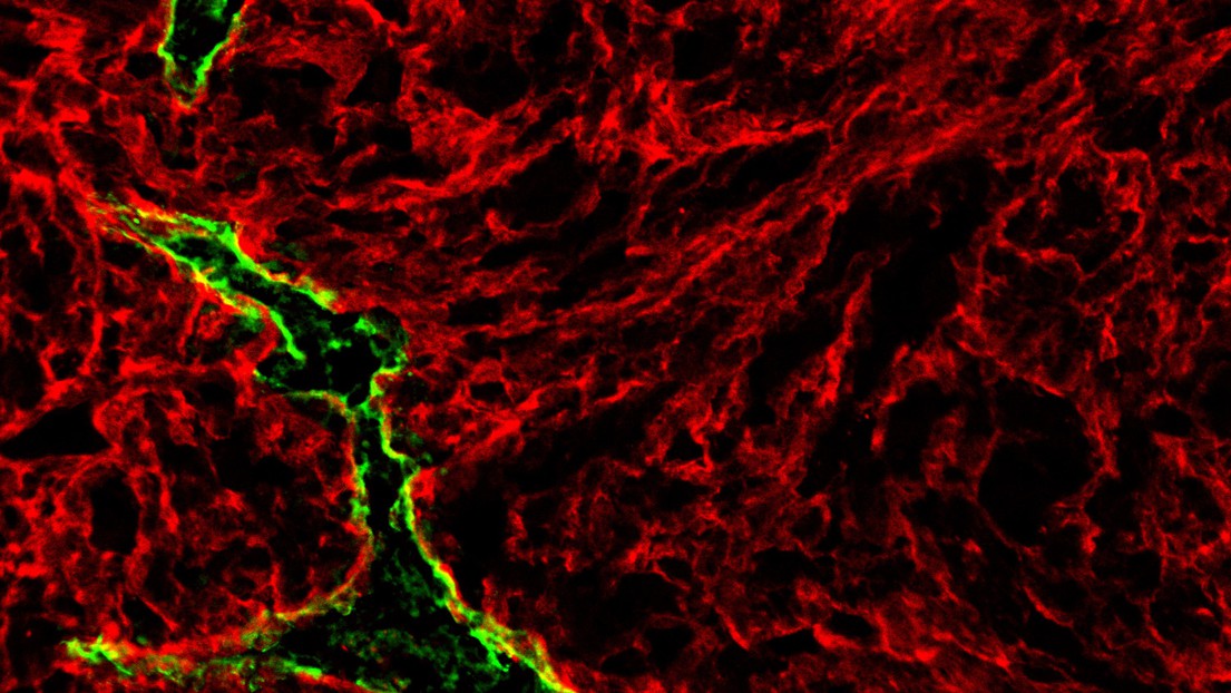 Intratumoral lymphatic vessel (green) imaged in the microenvironment (red) of a Braf-driven primary mouse melanoma tumor (credit: Manuel Fankhauser/Maria Broggi/EPFL)