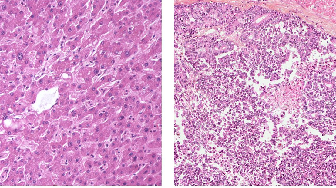 Normal liver tissue (left) and tissue with hepatoblastoma (right) © Etienne Meylan/EPFL
