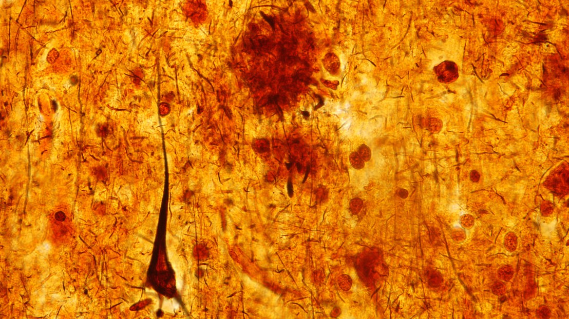 Enchevêtrements neurofibrillaires (crédit: Jose Luis Calvo Martin & Jose Enrique Garcia-mauriño Muzquiz/iStock) Enchevêtrements neurofibrillaires (crédit: Jose Luis Calvo Martin & Jose Enrique Garcia-mauriño Muzquiz/iStock)