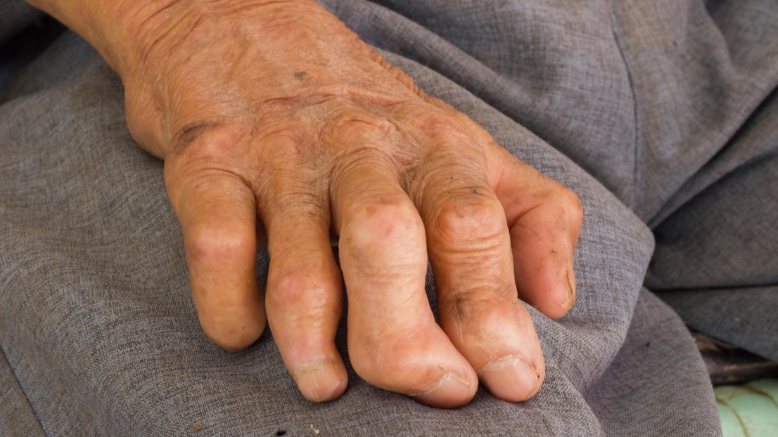 Leprosy's drug resistance and origin revealed by genome analysis EPFL