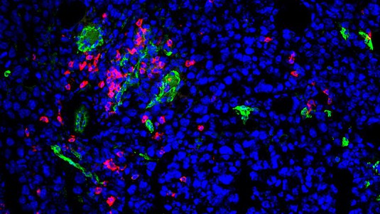 Les lymphocytes T CD8 (rouges) s'infiltrent dans un mélanome. Crédit: M. De Palma (EPFL)