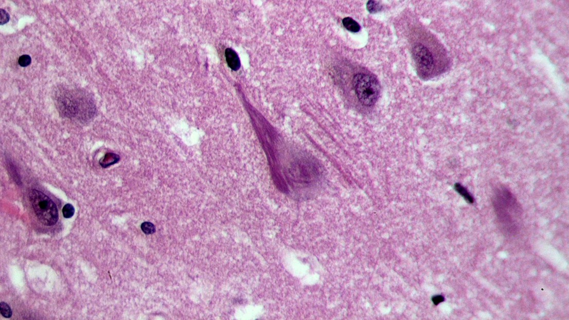 Neurofibrillary tangles (dark purple, elongated structure) in the hippocampus of an old person with Alzheimer-related pathology (credit: Wikimedia Commons user Patho)