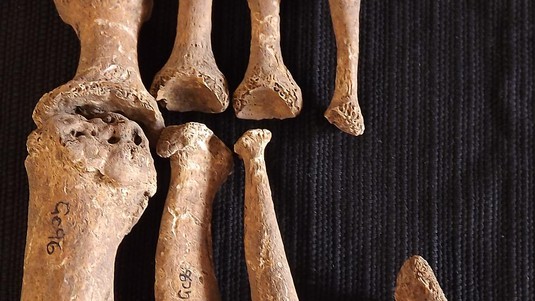 Human remains with leprosy (Great Chesterford, the UK's oldest known case). Photo: Sarah Inskip
