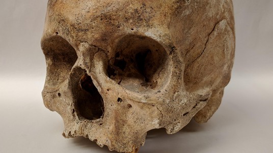 Human remains with leprosy (St. Jørgen cemetery, Denmark 1270-1560). Photo: Dorthe Dangvard Pedersen