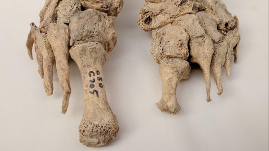 Human remains with leprosy (St. Jørgen cemetery, Denmark 1270-1560). Photo: Dorthe Dangvard Pedersen