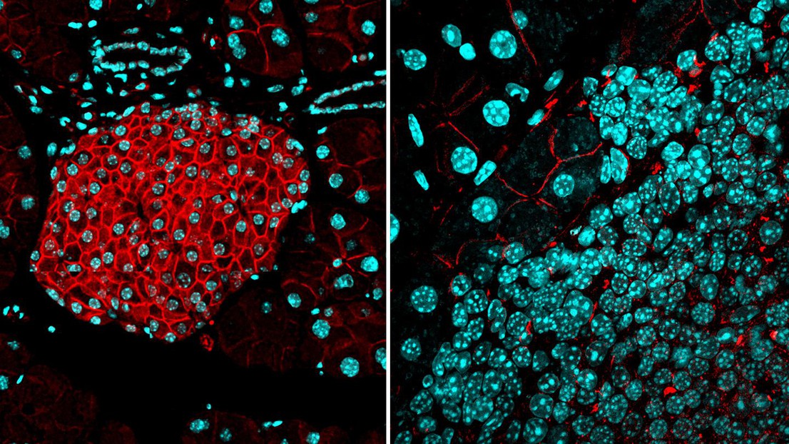 GAUCHE: une barrière de l'activine B (rouge) dans les îlots pancréatiques. DROITE: la barrière est absente dans les tumeurs des îlots de Langerhans. Cyan : noyaux de cellules. Crédit: I. Michael/EPFL