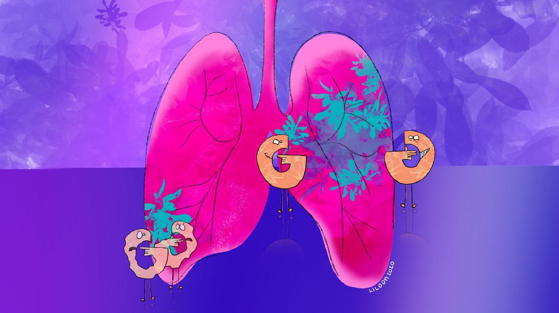 The “G” represents the highly expressed glucose transporters Glut1 and Glut3 in lung adenocarcinomas. Left:  the dual deletion impairing lung tumor growth. Credit: Liloon (Julie de Meyer)