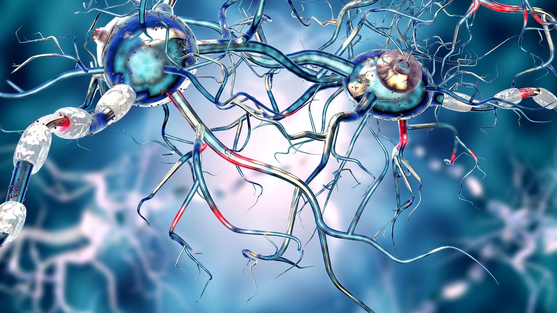 Huntington's disease causes the death of neurons. @iStockphoto