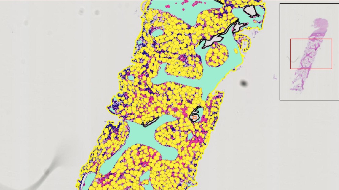 A screenshot of MarrowQuant annotating a bone marrow trephine biopsy from a patient surfing from chemotherapy-induced aplasia. Credit: Olaia Naveiras (EPFL)